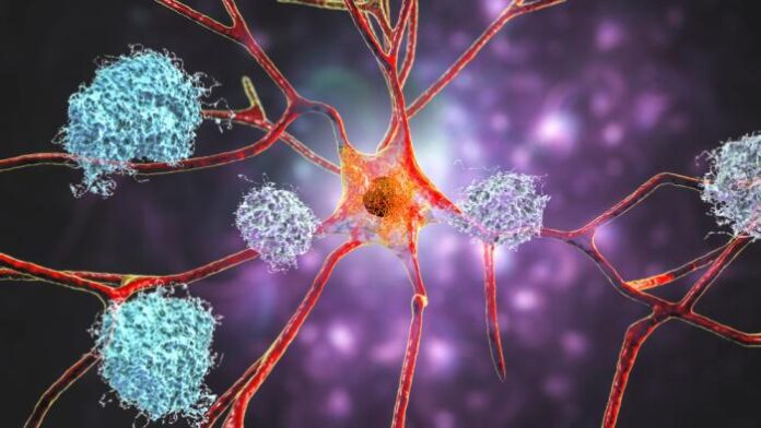 Lithium and Alzheimer’s